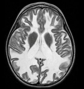 《白质消融性脑白质病（VWM）是怎样一种疾病？》